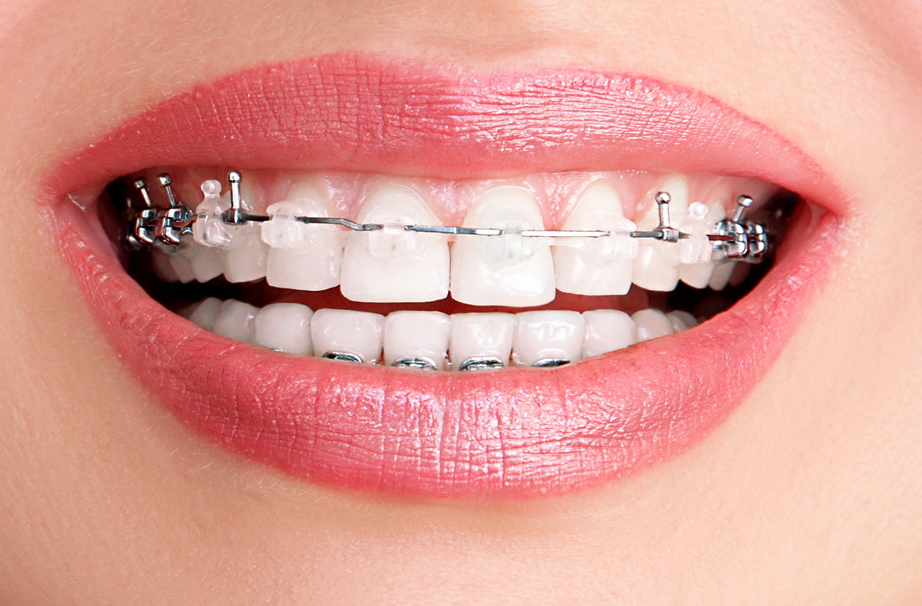 Feste Zahnspangen, Therapiegeräte, Selbstligierende Zahnspange
